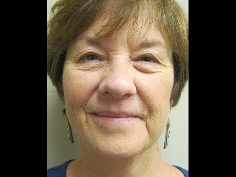 Facelift Before & After Gallery - Patient 87552124 - Image 1