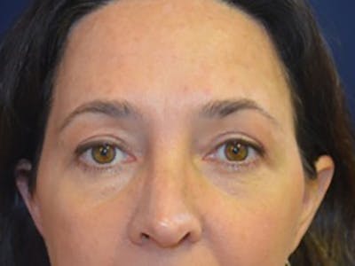 Eyelids Before & After Gallery - Patient 87552128 - Image 2