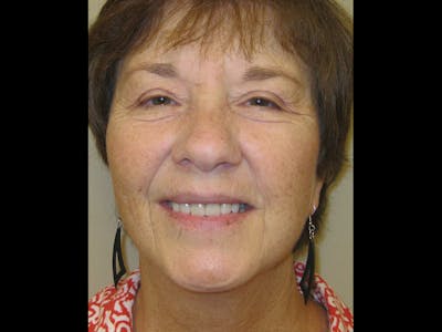 Facelift Before & After Gallery - Patient 87552124 - Image 2