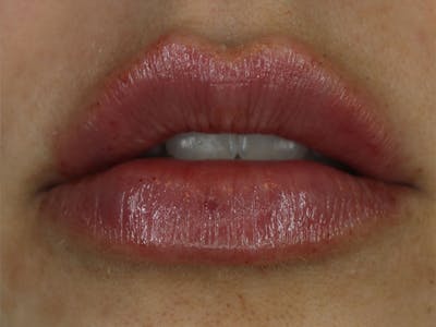 Lip Filler Before & After Gallery - Patient 87552126 - Image 2