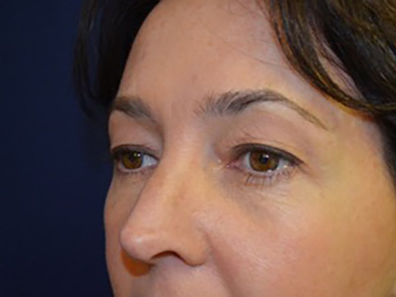 Eyelids Before & After Gallery - Patient 87552128 - Image 3