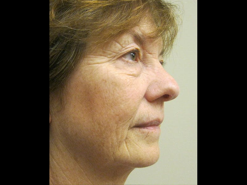 Facelift Before & After Gallery - Patient 87552124 - Image 3