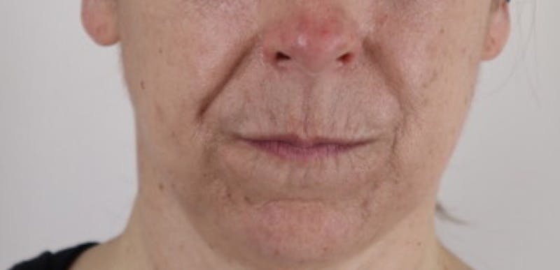 Liquid Lift Before & After Gallery - Patient 87552127 - Image 1