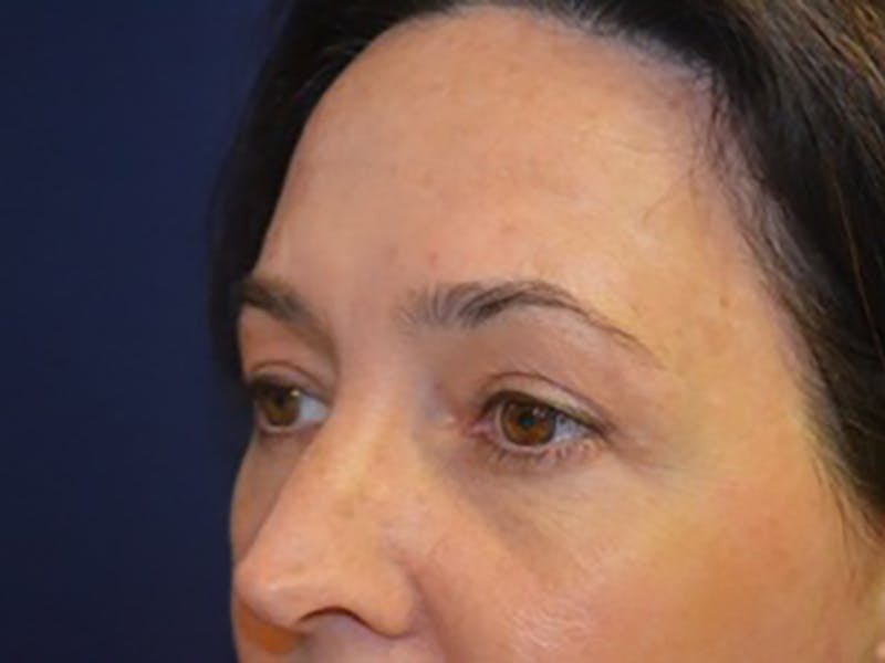 Eyelids Before & After Gallery - Patient 87552128 - Image 4