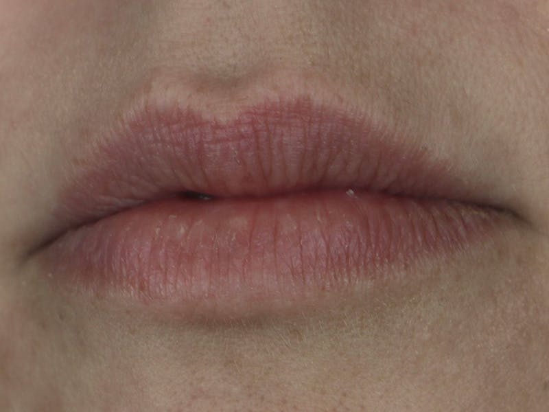 Lip Filler Before & After Gallery - Patient 87552126 - Image 3