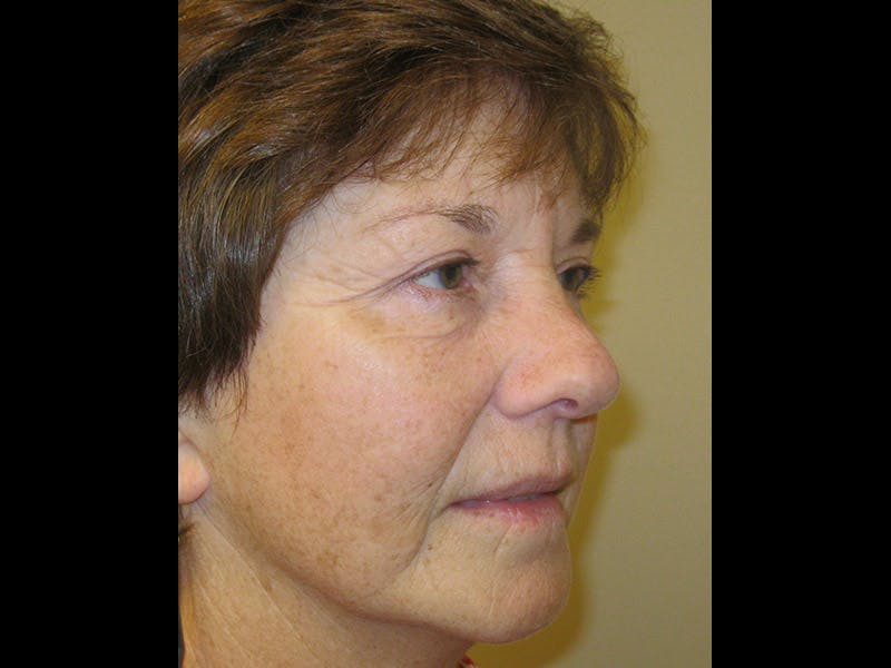 Facelift Before & After Gallery - Patient 87552124 - Image 4