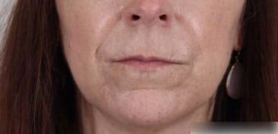 Liquid Lift Before & After Gallery - Patient 87552127 - Image 2