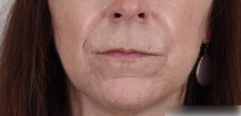 Liquid Lift Before & After Gallery - Patient 87552127 - Image 2