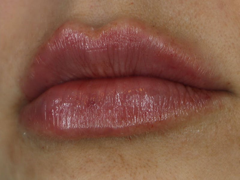 Lip Filler Before & After Gallery - Patient 87552126 - Image 4