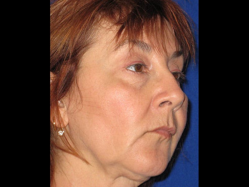 Facelift Before & After Gallery - Patient 87552134 - Image 1