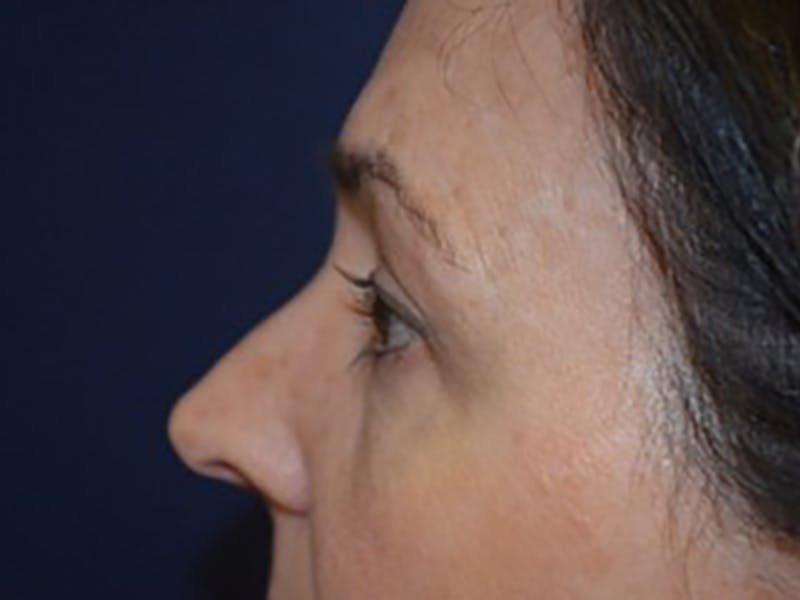 Eyelids Before & After Gallery - Patient 87552128 - Image 6