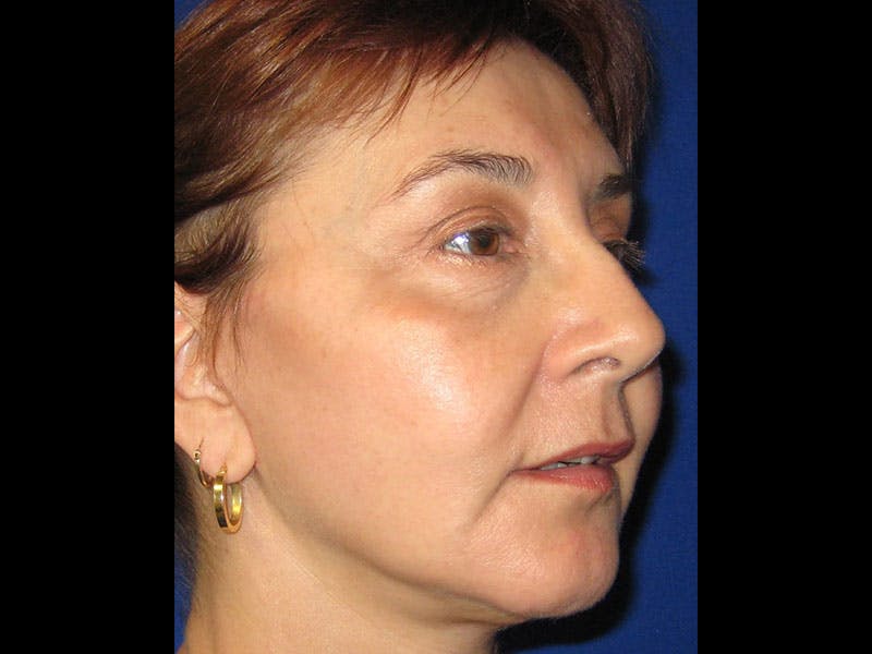 Facelift Before & After Gallery - Patient 87552134 - Image 2