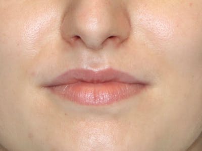 Lip Filler Before & After Gallery - Patient 87552133 - Image 1