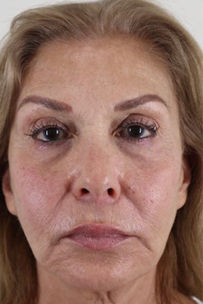 Liquid Lift Before & After Gallery - Patient 87552132 - Image 2