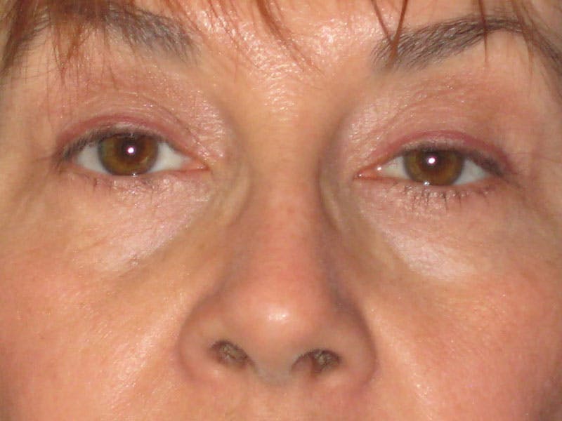Facelift Before & After Gallery - Patient 87552134 - Image 3