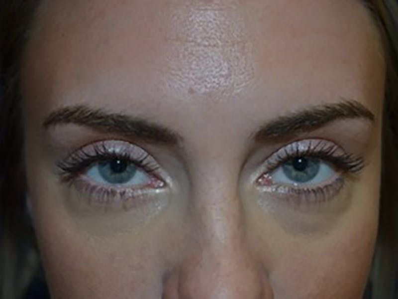 Eyelids Before & After Gallery - Patient 87552137 - Image 1