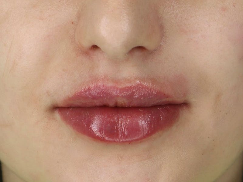 Lip Filler Before & After Gallery - Patient 87552133 - Image 2