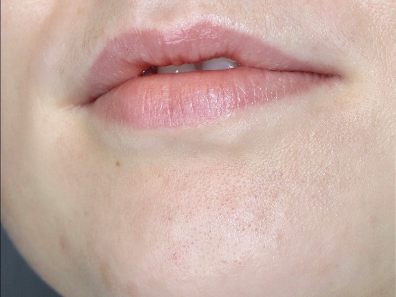 Lip Filler Before & After Gallery - Patient 87552133 - Image 3