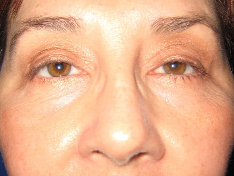 Facelift Before & After Gallery - Patient 87552134 - Image 4