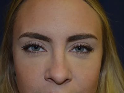 Eyelids Before & After Gallery - Patient 87552137 - Image 2