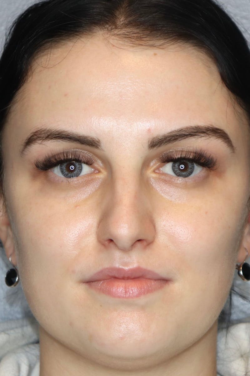 Liquid Lift Before & After Gallery - Patient 87552136 - Image 1