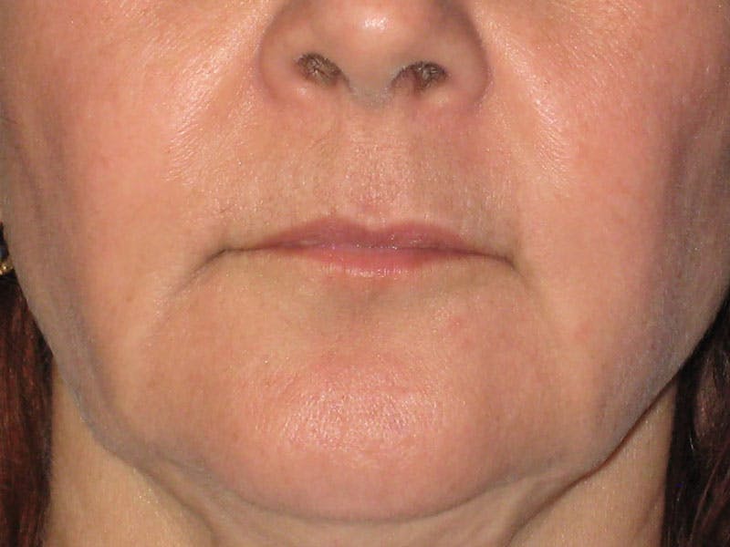 Facelift Before & After Gallery - Patient 87552134 - Image 5