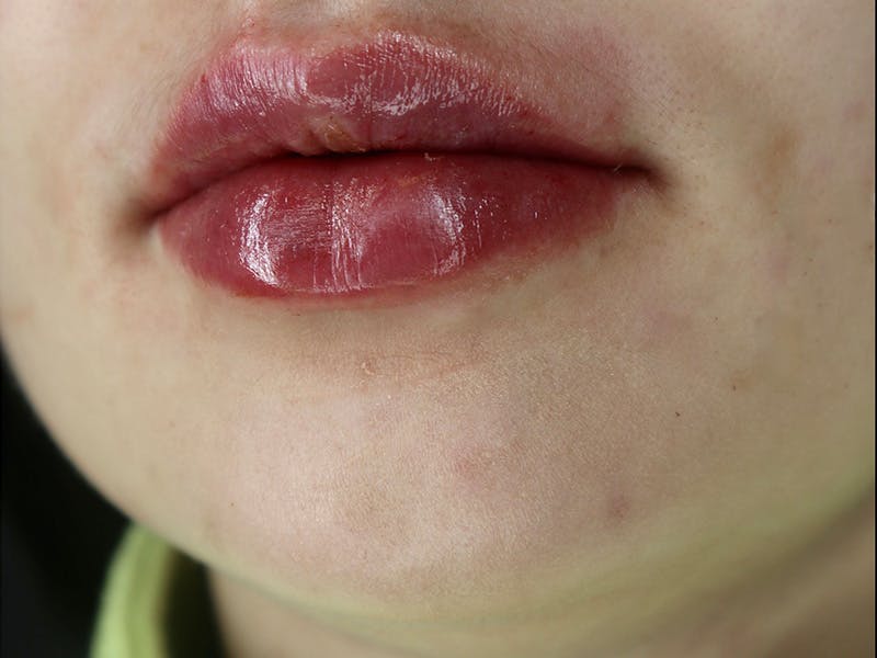 Lip Filler Before & After Gallery - Patient 87552133 - Image 4