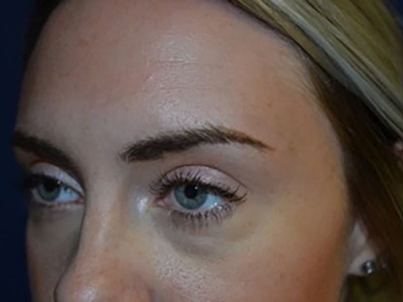 Eyelids Before & After Gallery - Patient 87552137 - Image 3