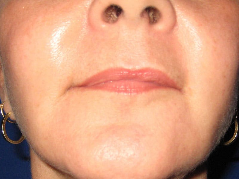 Facelift Before & After Gallery - Patient 87552134 - Image 6