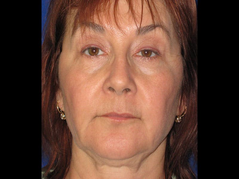 Facelift Before & After Gallery - Patient 87552134 - Image 7