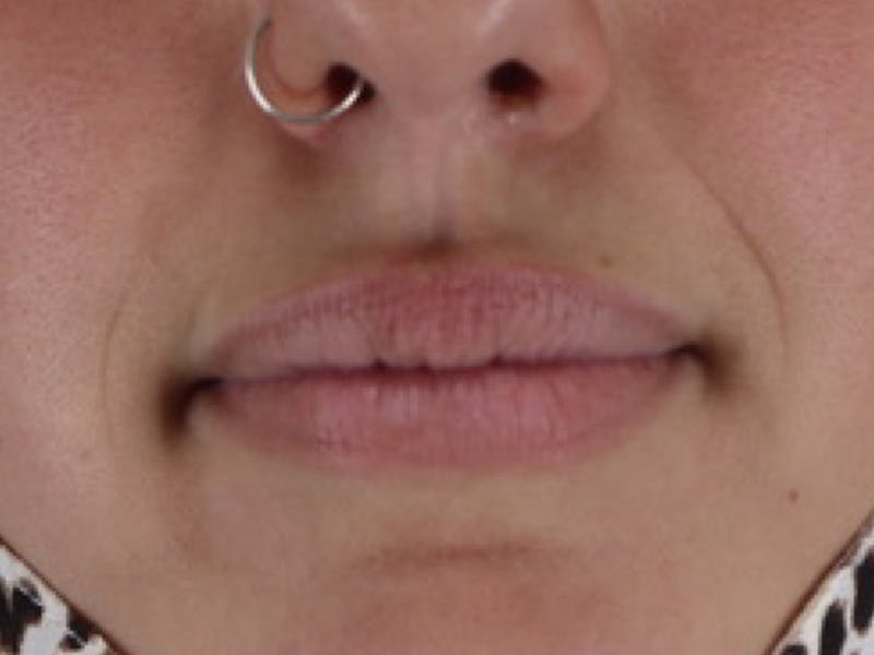 Lip Filler Before & After Gallery - Patient 87552135 - Image 1