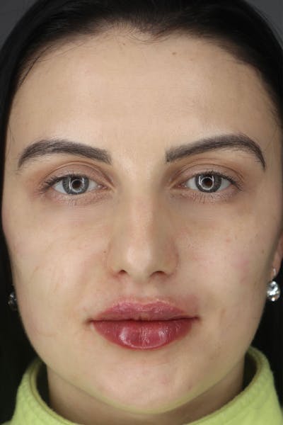 Liquid Lift Before & After Gallery - Patient 87552136 - Image 2