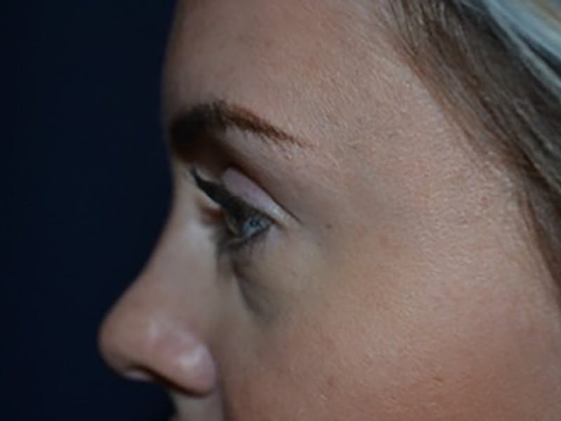 Eyelids Before & After Gallery - Patient 87552137 - Image 5
