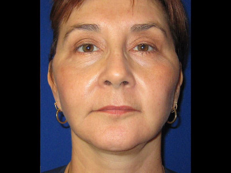 Facelift Before & After Gallery - Patient 87552134 - Image 8