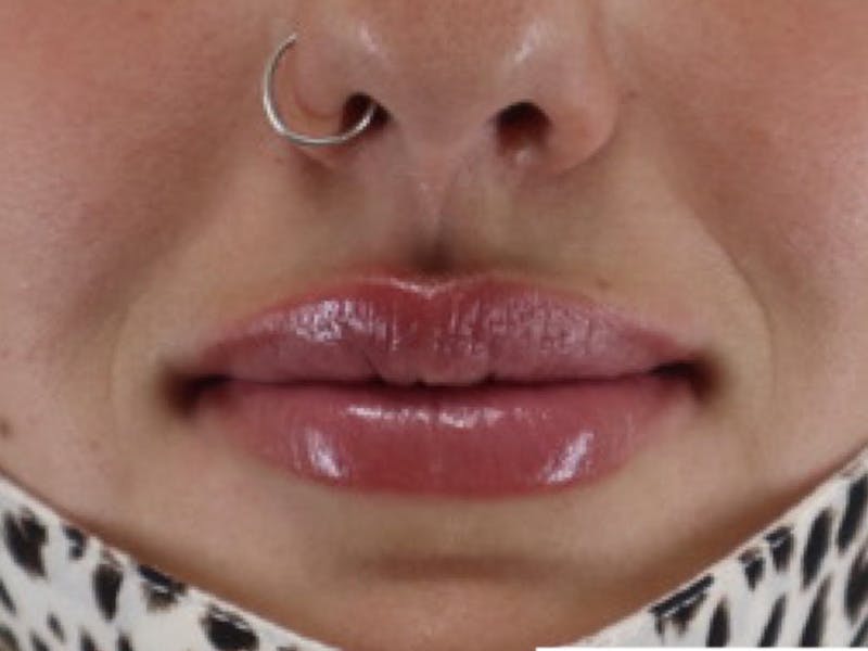 Lip Filler Before & After Gallery - Patient 87552135 - Image 2