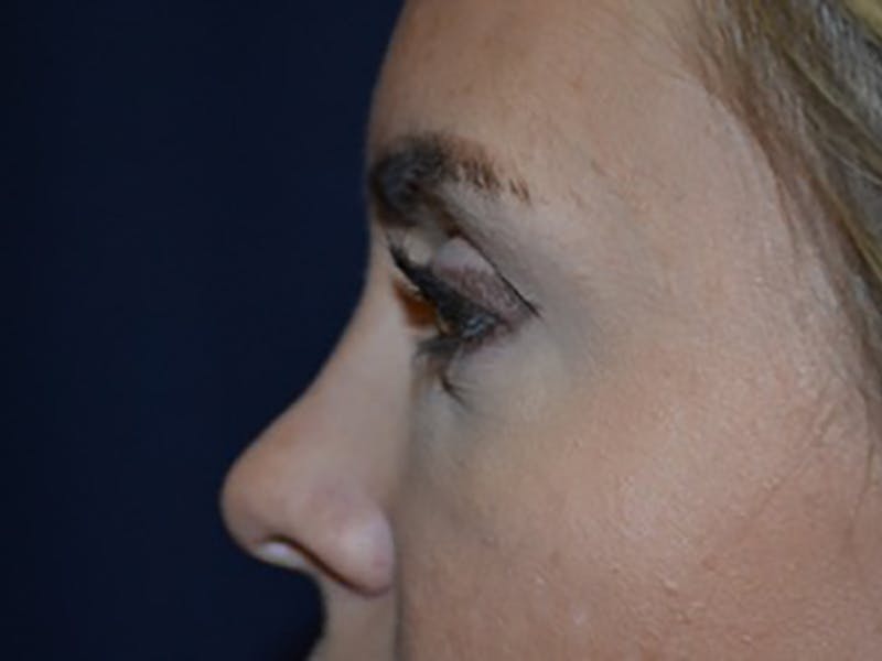 Eyelids Before & After Gallery - Patient 87552137 - Image 6