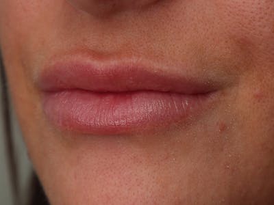 Lip Filler Before & After Gallery - Patient 87552144 - Image 1