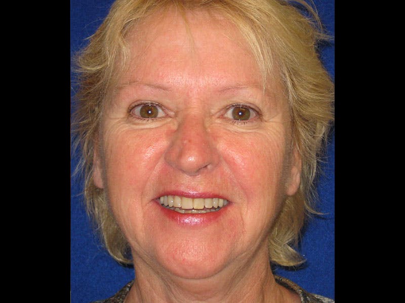 Facelift Before & After Gallery - Patient 87552145 - Image 1