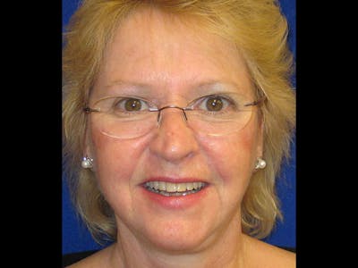 Facelift Before & After Gallery - Patient 87552145 - Image 2