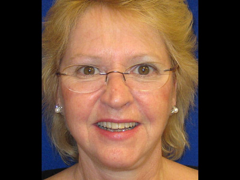 Facelift Before & After Gallery - Patient 87552145 - Image 2