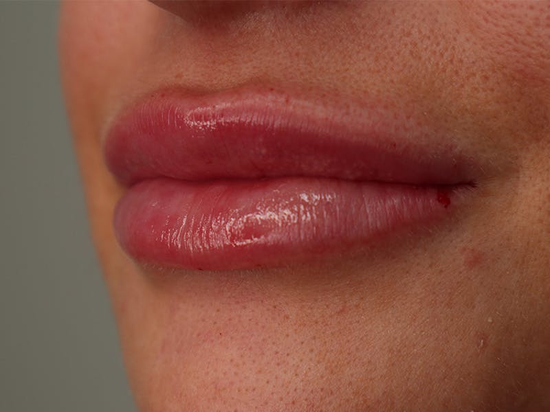 Lip Filler Before & After Gallery - Patient 87552144 - Image 2