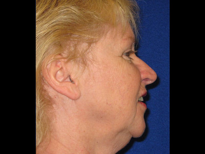 Facelift Before & After Gallery - Patient 87552145 - Image 3