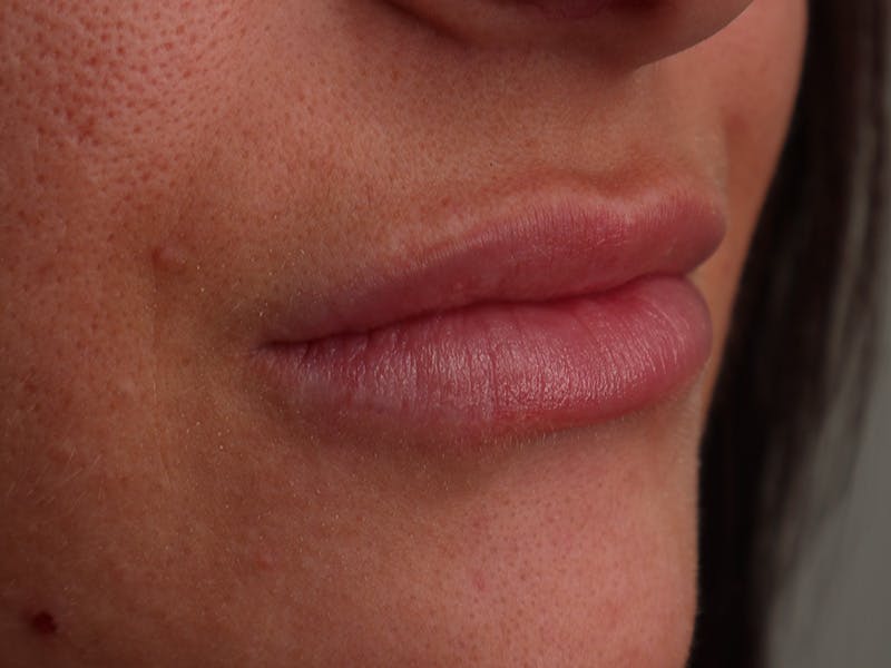 Lip Filler Before & After Gallery - Patient 87552144 - Image 3