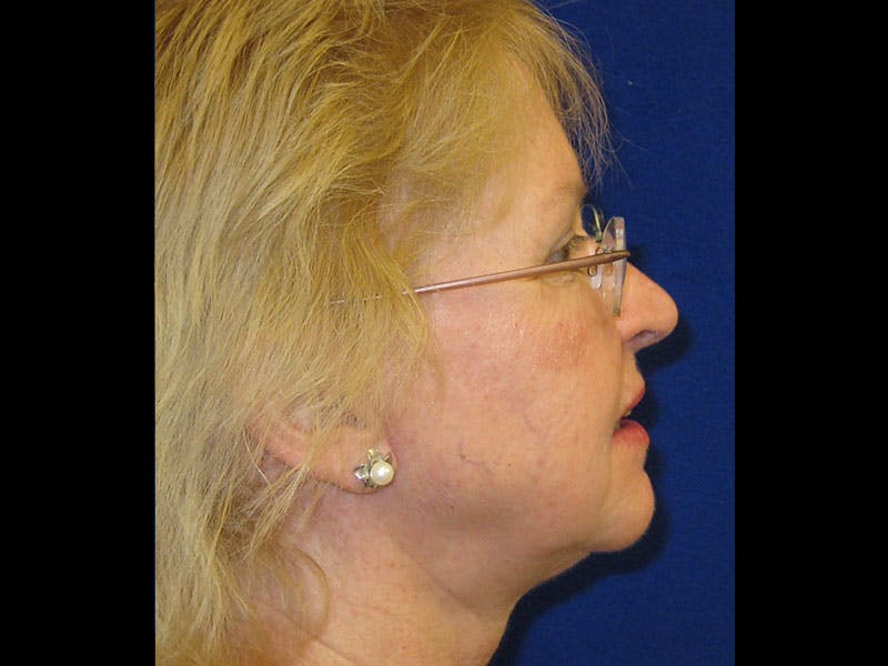 Facelift Before & After Gallery - Patient 87552145 - Image 4
