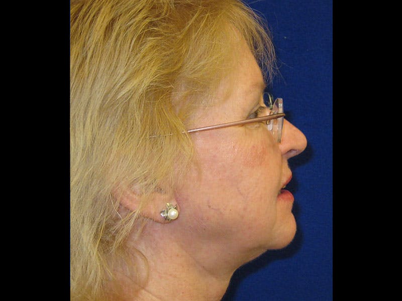 Facelift Before & After Gallery - Patient 87552145 - Image 4