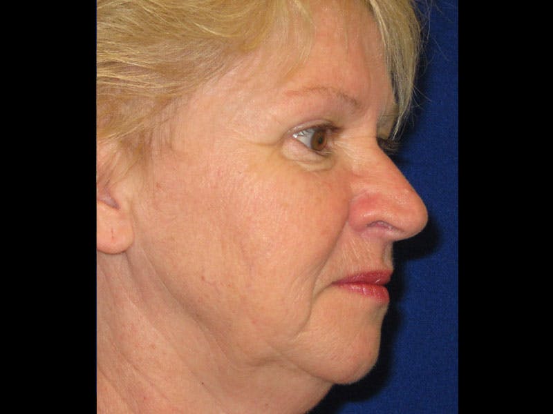 Facelift Before & After Gallery - Patient 87552145 - Image 5