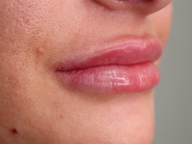 Lip Filler Before & After Gallery - Patient 87552144 - Image 4