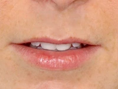 Lip Filler Before & After Gallery - Patient 87552152 - Image 1