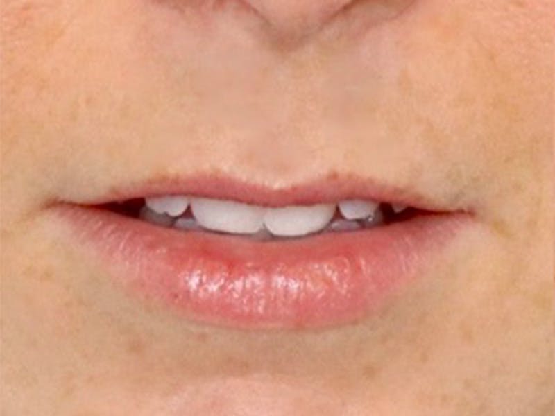 Lip Filler Before & After Gallery - Patient 87552152 - Image 1