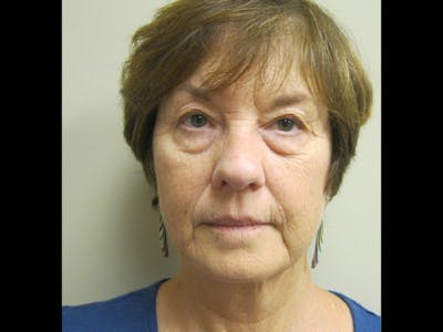 Facelift Before & After Gallery - Patient 87552150 - Image 1